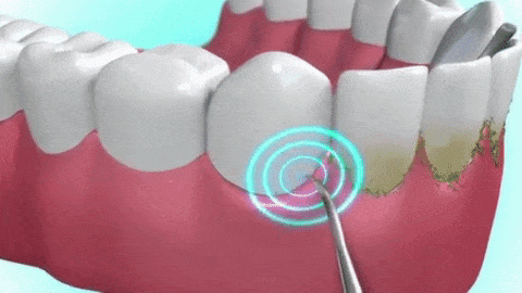 Limpiador ultrasónico de dientes SMILY – Frilla.es